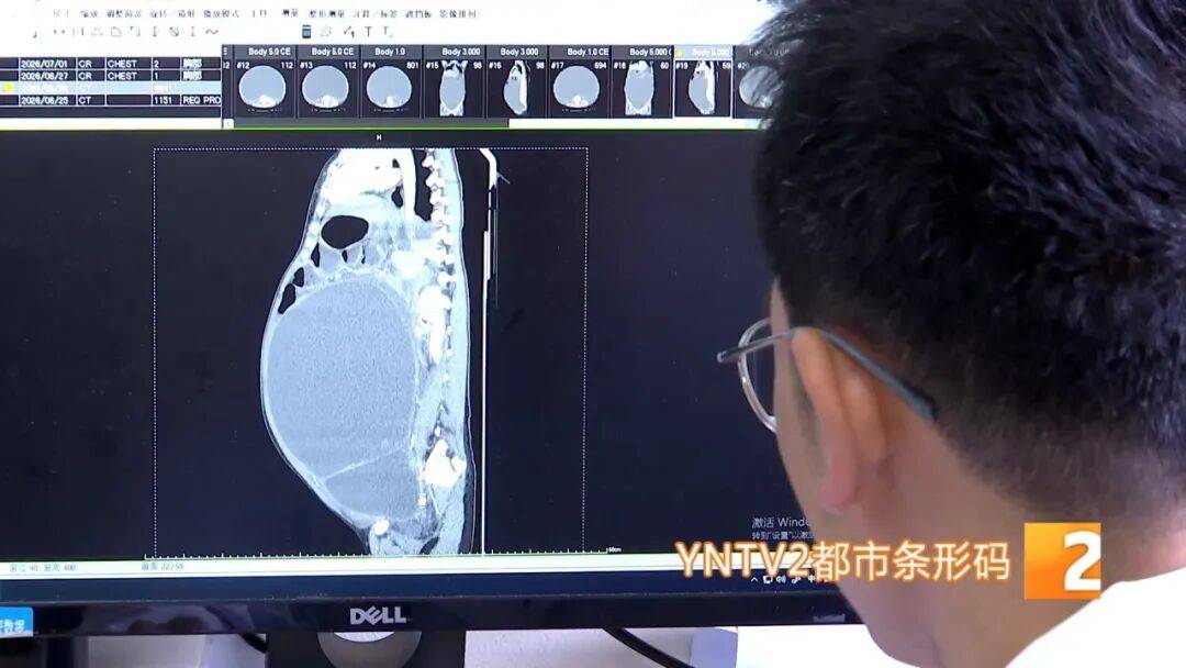 被误会怀孕三年！云南24岁女子腹部隆起比篮球还大，手术取出15公斤巨大囊肿